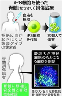 iPS诱导性多能干细胞移植术为脊椎损伤的慢性病患者带来希望