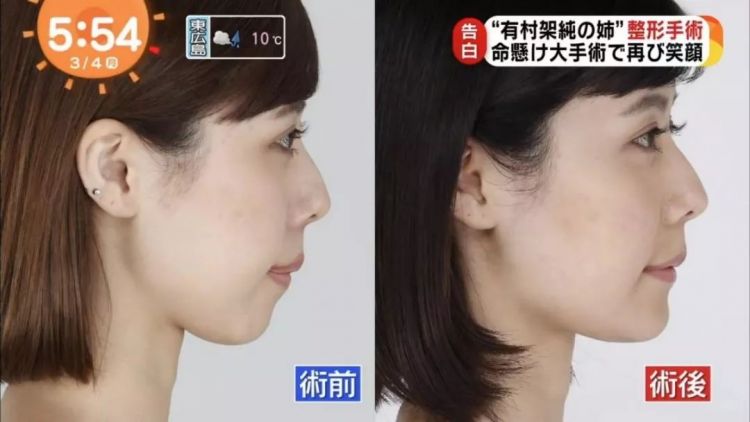 同样是整容 怎么他就被骂 日本通