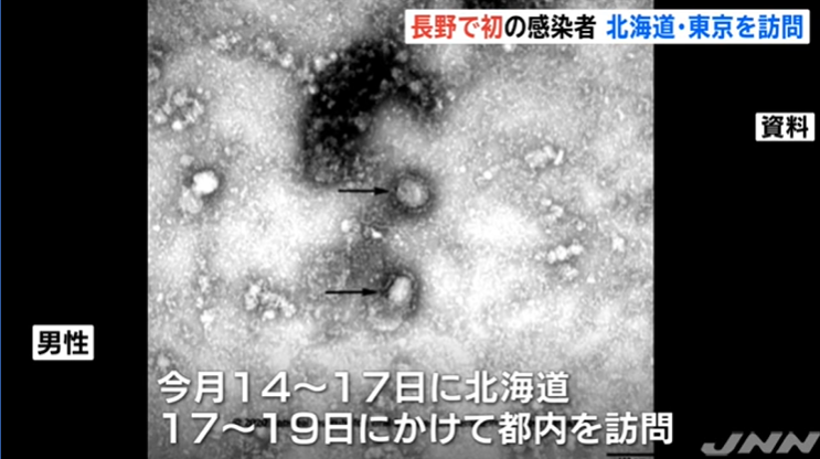 日本长野县确诊首例新型冠状病毒肺炎病例