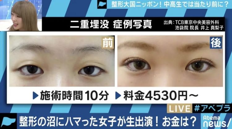 日本17岁女高中生整形记 日本通 日本17岁女高中生整形记 日本通