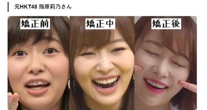日本女孩的牙，为什么大多不好看？