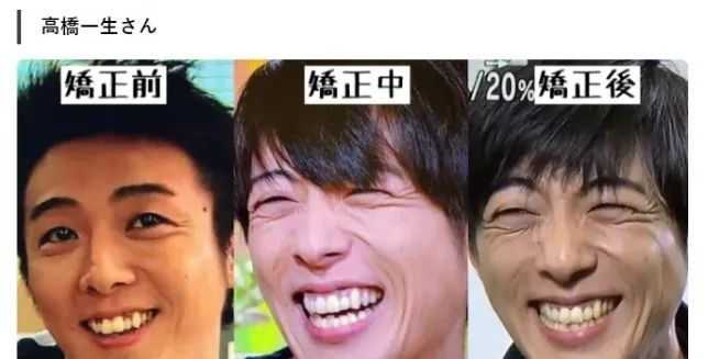 日本女孩的牙，为什么大多不好看？