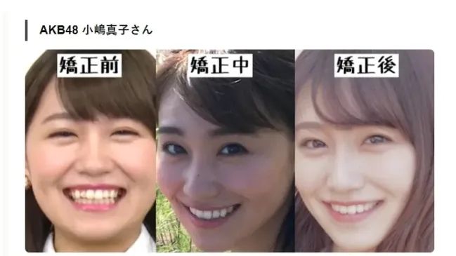 日本女孩的牙，为什么大多不好看？