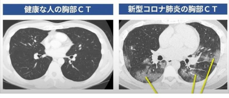警惕日本免疫性肺炎