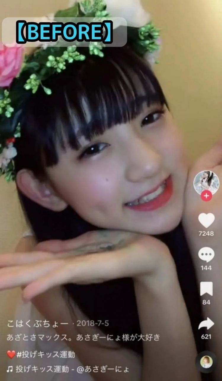 15岁少女整容失败引发热议，外表成‘蛇精’，网友愤怒：最狠的不是医生，而是她妈妈