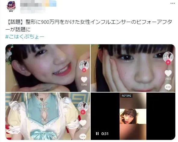 15岁少女整容失败引发热议，外表成‘蛇精’，网友愤怒：最狠的不是医生，而是她妈妈