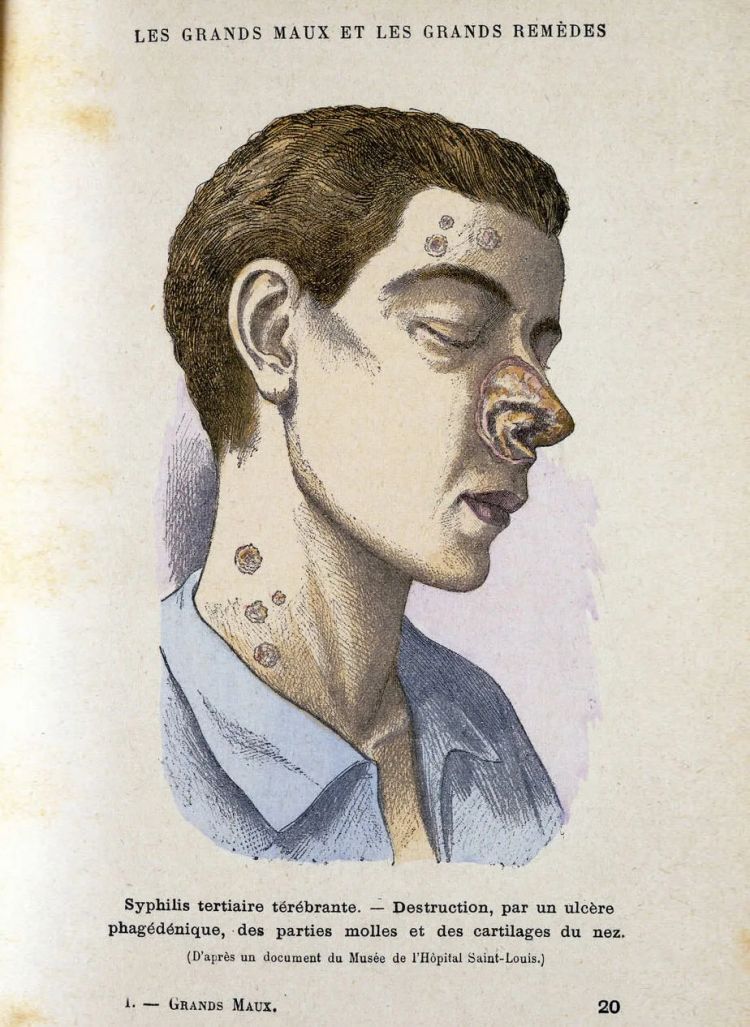 日本飙升的梅毒，到底是什么毒？