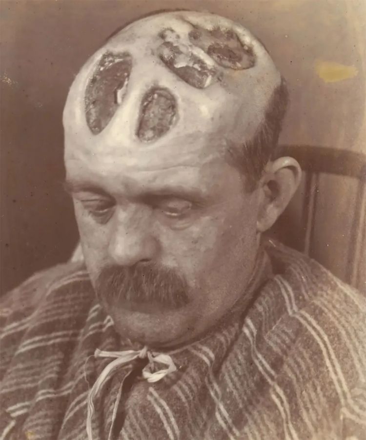 日本飙升的梅毒，到底是什么毒？